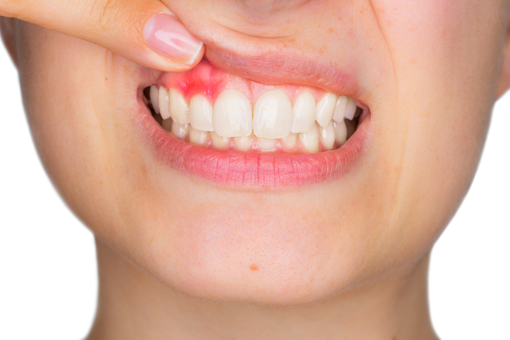 gum disease types risks symptoms