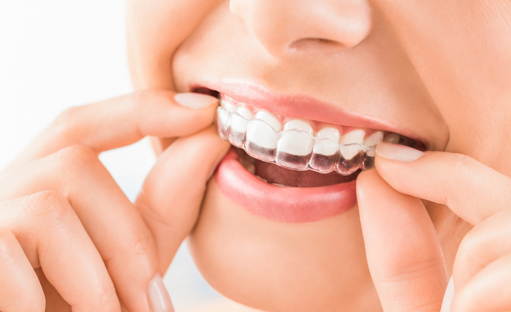 Invisalign improve oral health