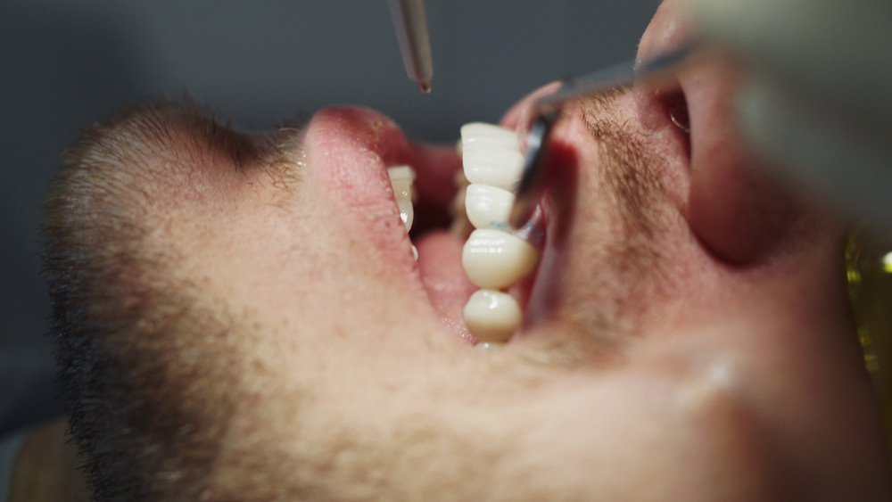 teeth cleaning